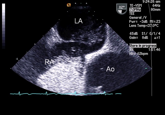 PFO 和偏头痛？新研究关注房间隔动脉瘤| tctmd.com